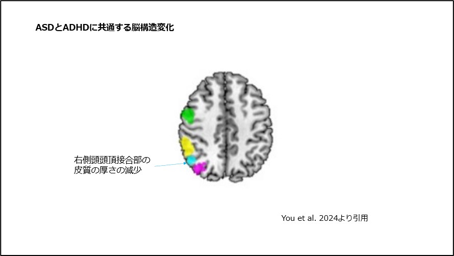 ASDとADHDに共通する脳構造変化