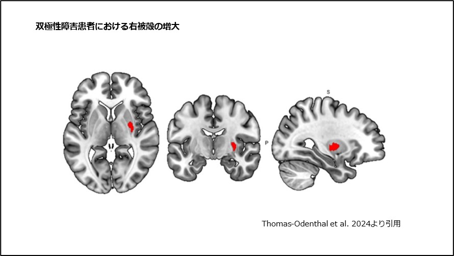 双極性障害患者における右被殻の増大