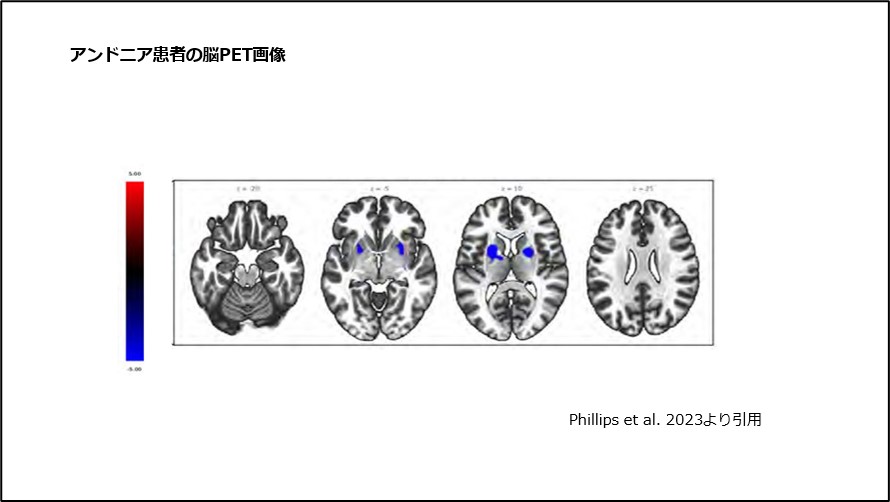 アンドニア患者の脳PET画像
