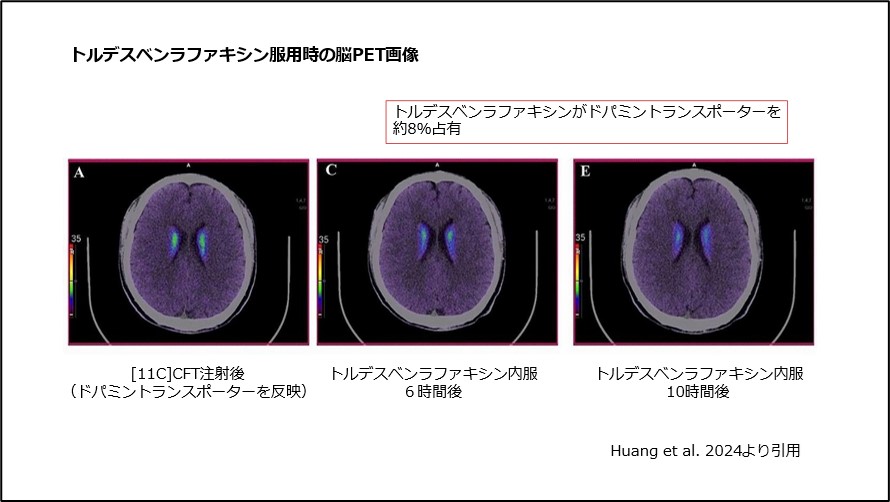 トルデスベンラファキシン服用時の脳PET画像