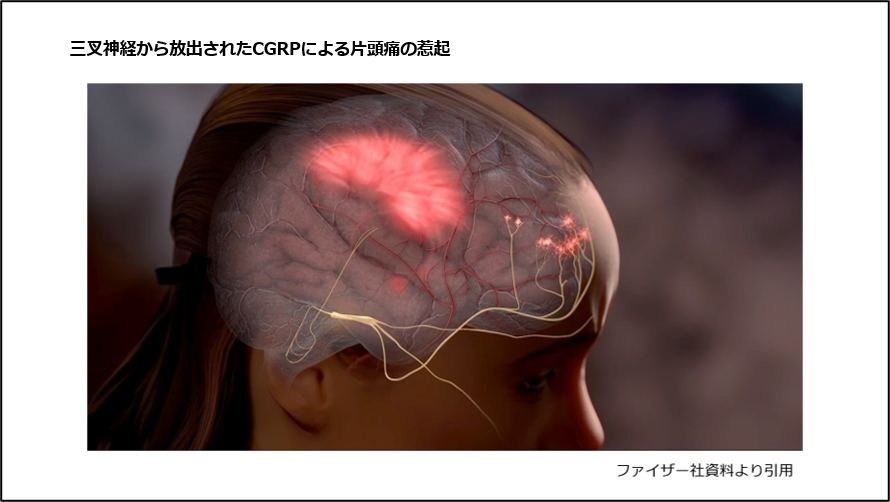 三叉神経から放出されたCGRPによる片頭痛の惹起
